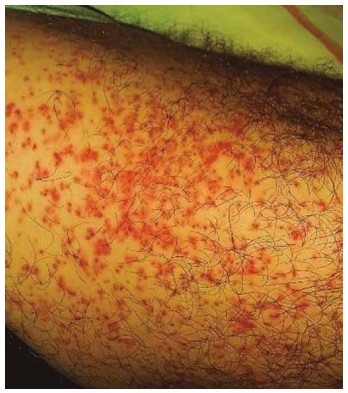 Figura 3. Dermatitis producida en el paciente por
